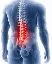 Estenosis espinal lumbar